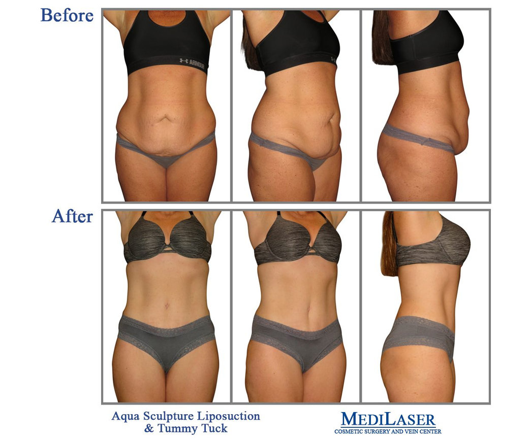 Week Three: Tummy Tuck Sale! - Medilaser Surgery and Vein Center