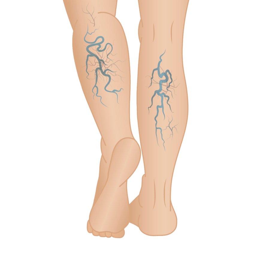 Why Do Varicose Veins Cause Skin Changes?: Center for Varicose