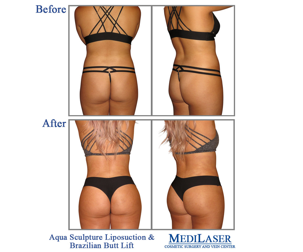 Brazilian-Butt-Lift-BBL-Before-After - Medilaser Surgery and Vein