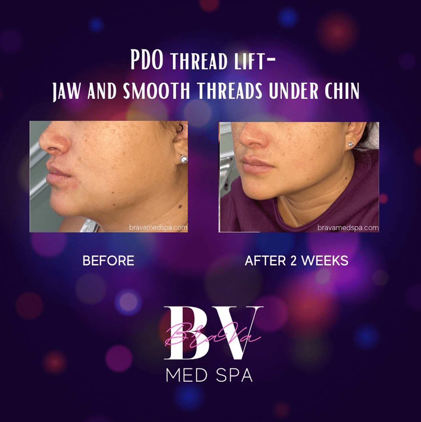 facial-tightening-pdo-threads-brava-medspa-murrells-inlet-sc