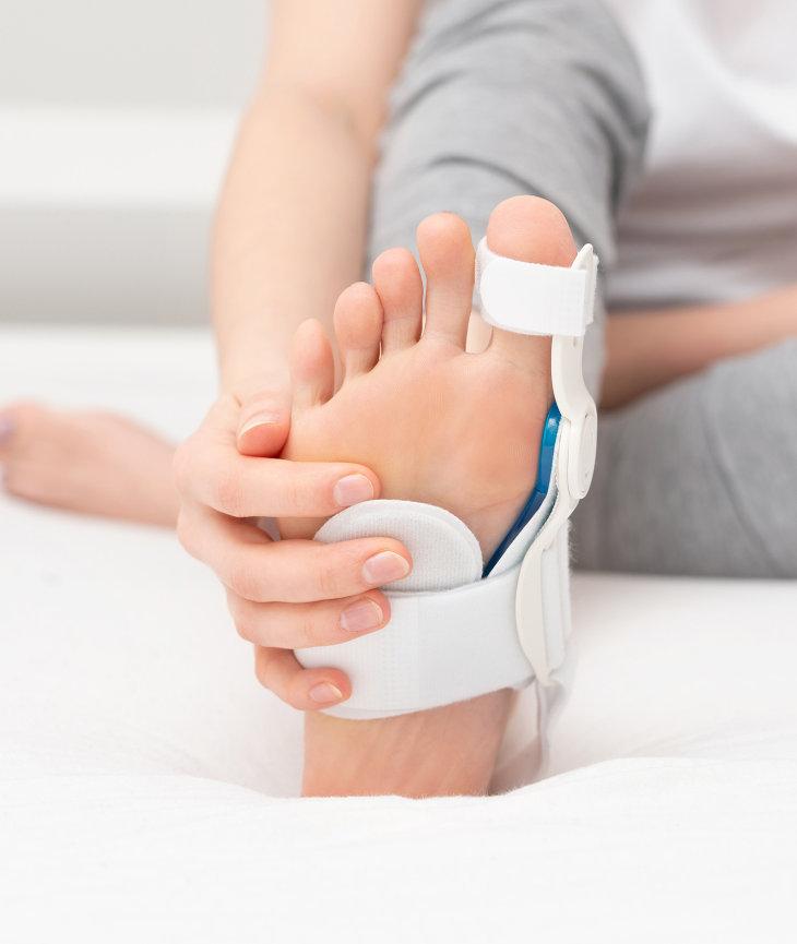 Bunions in Athletes Foot & Ankle Centers of Frisco and Plano