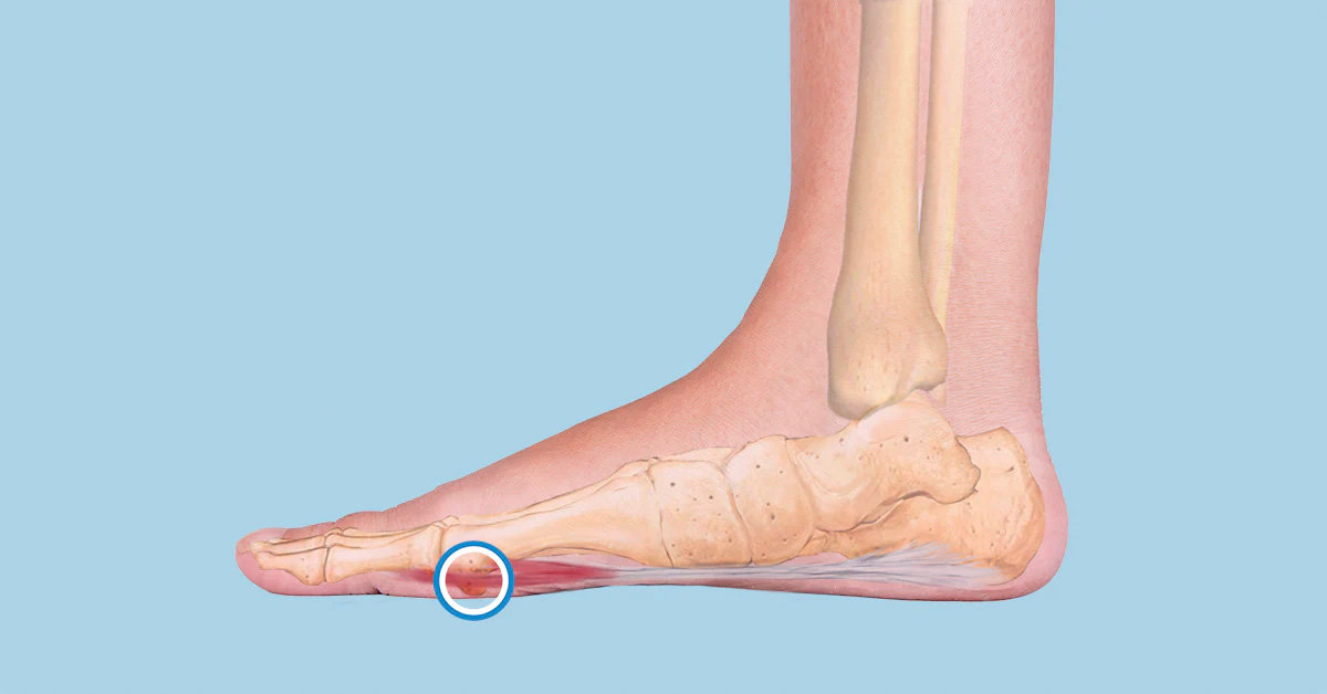 Sesamoids and Accessory Bones - Foot & Ankle Centers of Frisco and Plano