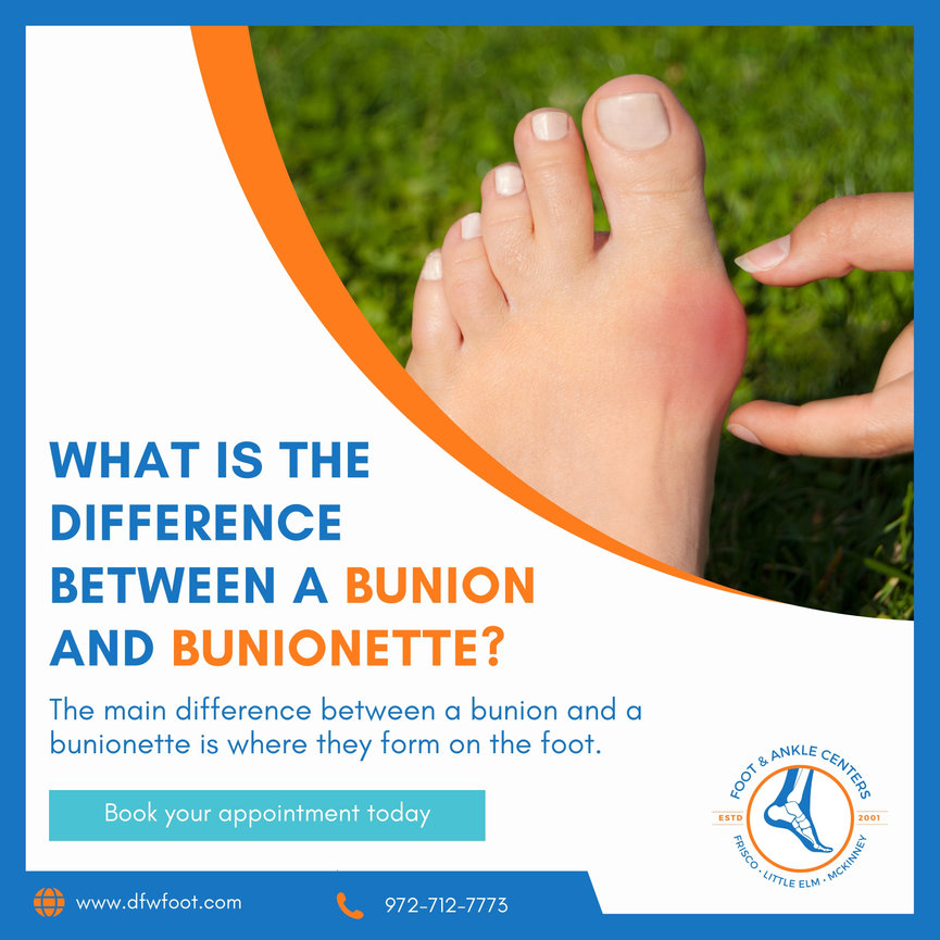 What is the Difference Between a Bunion and Bunionette? - Foot & Ankle ...