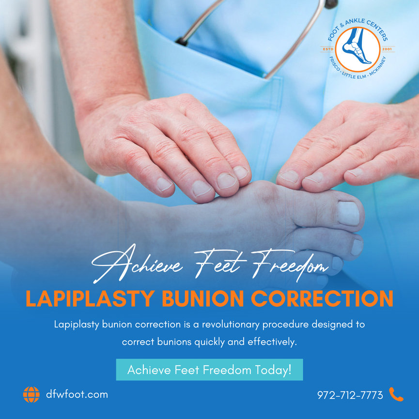 Achieve Feet Freedom With Lapiplasty Bunion Correction Foot Ankle Centers Of Frisco And Plano