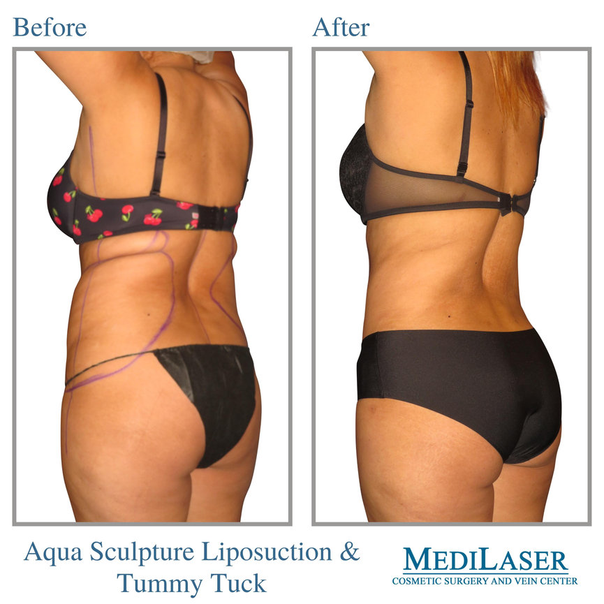 Tummy Tuck and Liposuction Before and After Frisco Texas - Medilaser Surgery  and Vein Center