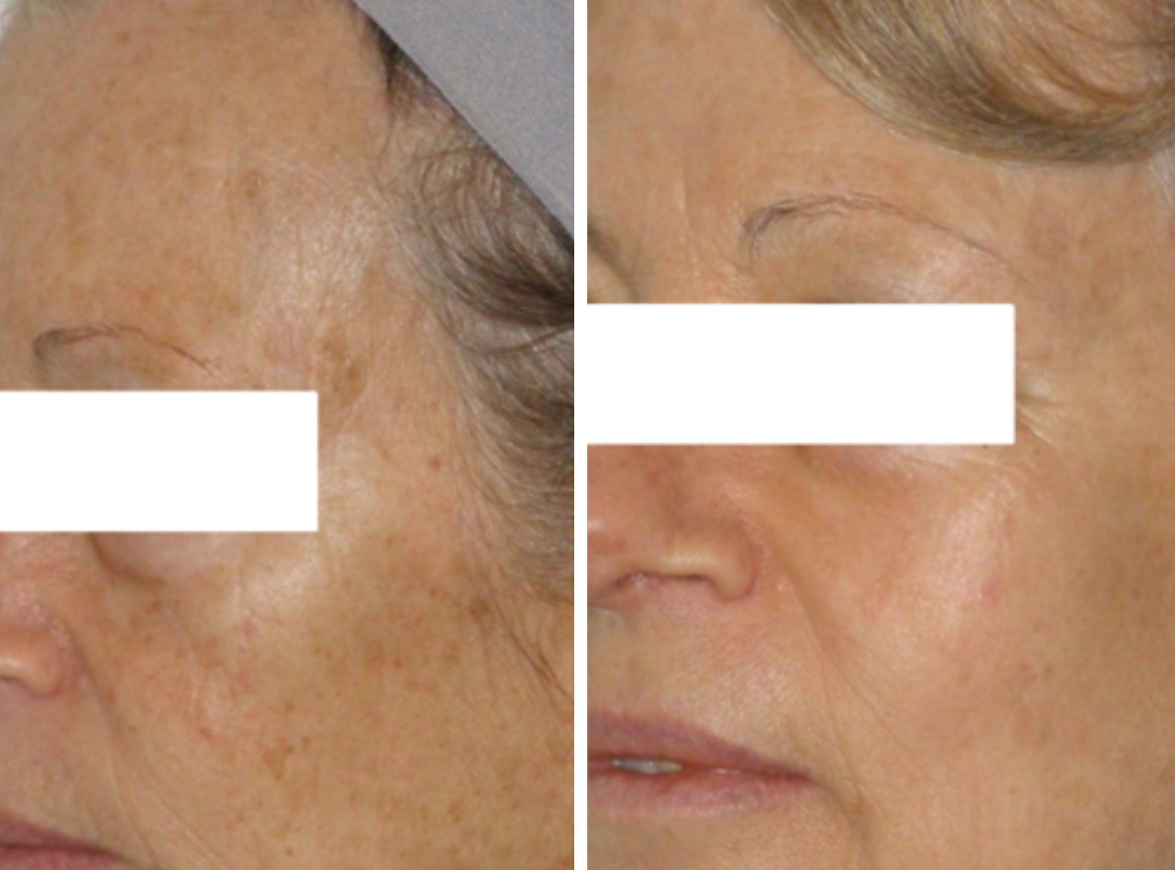 IPL Laser Facial Feel Ideal 360 Med Spa Southlake, TX