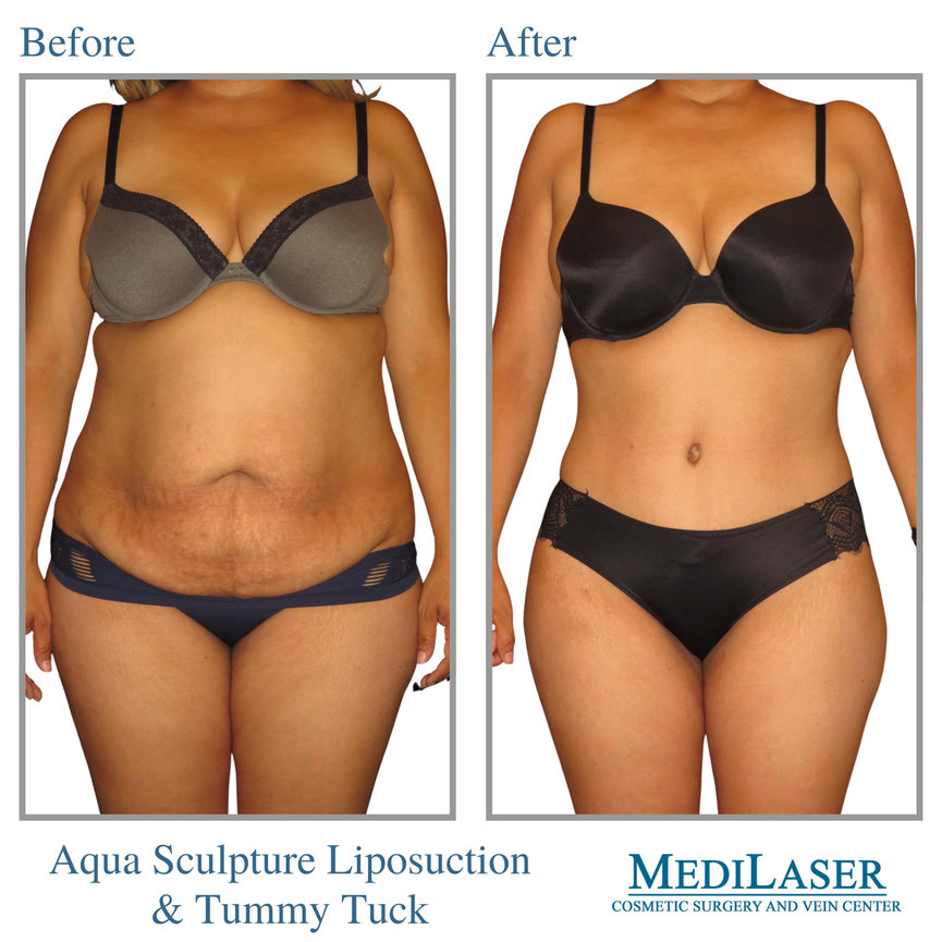 Liposuction Before and After Video