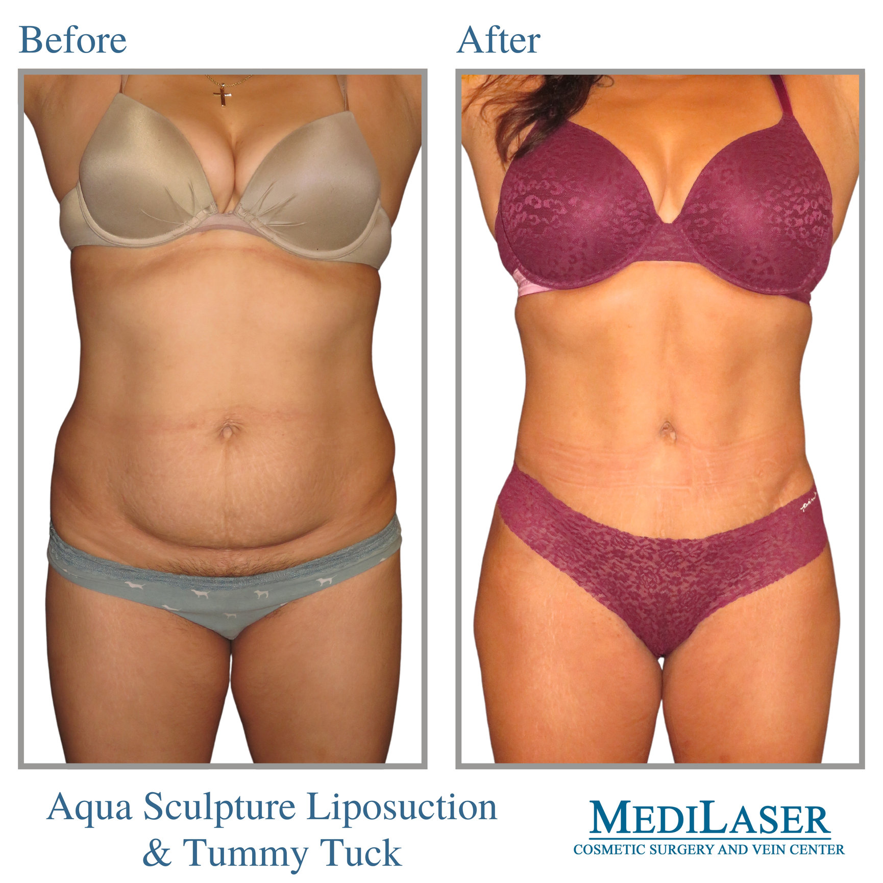 Tummy Tuck Liposuction Before And After Medilaser Surgery And Vein Center