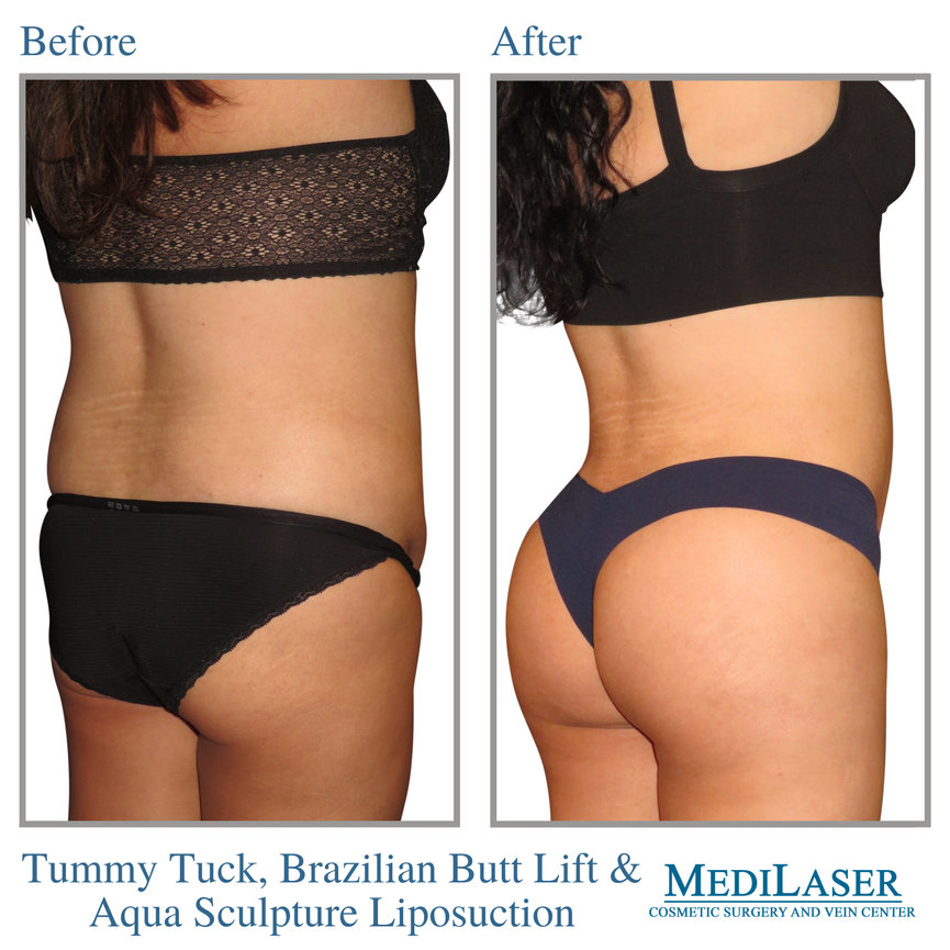 Brazilian Butt Lift BBL Before and After - Medilaser Surgery and